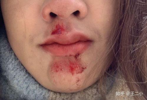 脸部擦伤图片,捕捉意外瞬间的真实写照